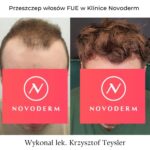 przeszczep włosów FUE