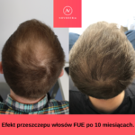 przeszczep włosów